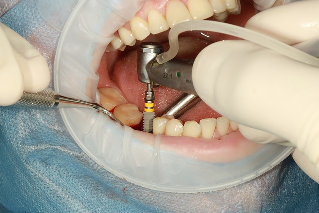 Vorteile der Zahnimplantatlösung neben den eigenen Zähnen und verbessert mit der Softwarelösung simq medical 